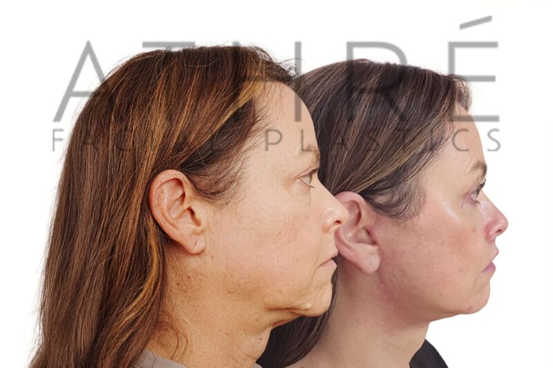 Facial rejuvenation surgery including facelift and blepharoplasty performed by Dr. Raghu Athré.