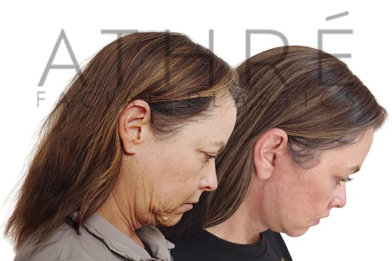 Before and after 4D Facelift™, upper and lower blepharoplasty, and lip lift by Dr. Raghu Athré in 53-year-old female patient.