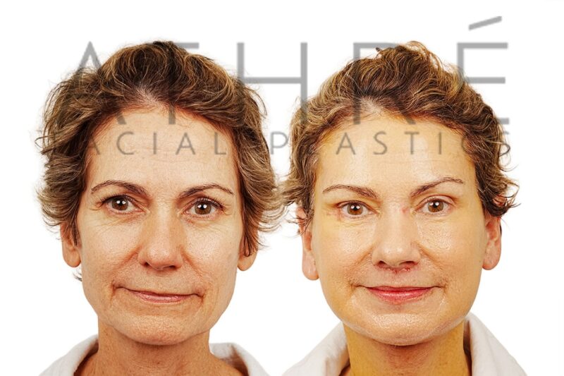 Before and after deep plane facelift and brow lift by Dr. Raghu Athré in 59-year-old female patient.