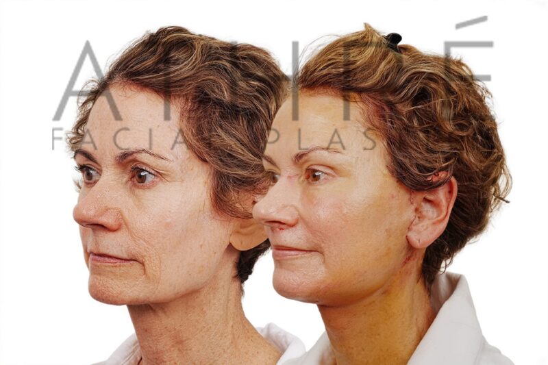 Female patient 8 days after 4D Facelift™, lip lifts, and deep neck lift by Dr. Raghu Athré.