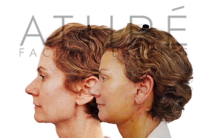 Before and after facial rejuvenation with facelift and full-face chemical peel by Dr. Raghu Athré.