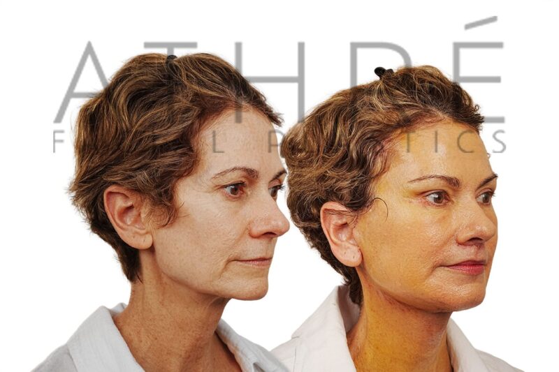 59-year-old woman shown after stem cell nanofat treatment and facial resurfacing performed by Dr. Raghu Athré.