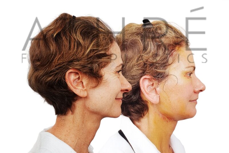 Facial rejuvenation surgery including facelift, brow lift, and lip lift procedures performed by Dr. Raghu Athré.