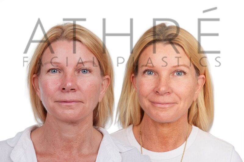 Before and after revision deep plane facelift and neck lift by Dr. Raghu Athré in 53-year-old female patient.