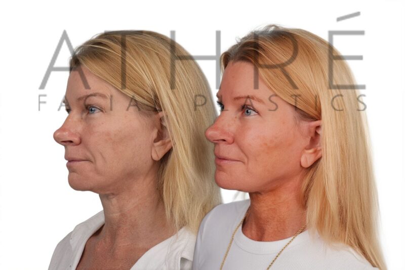 Female patient after revision 4D Facelift™ and correction of cobra neck deformity by Dr. Raghu Athré.