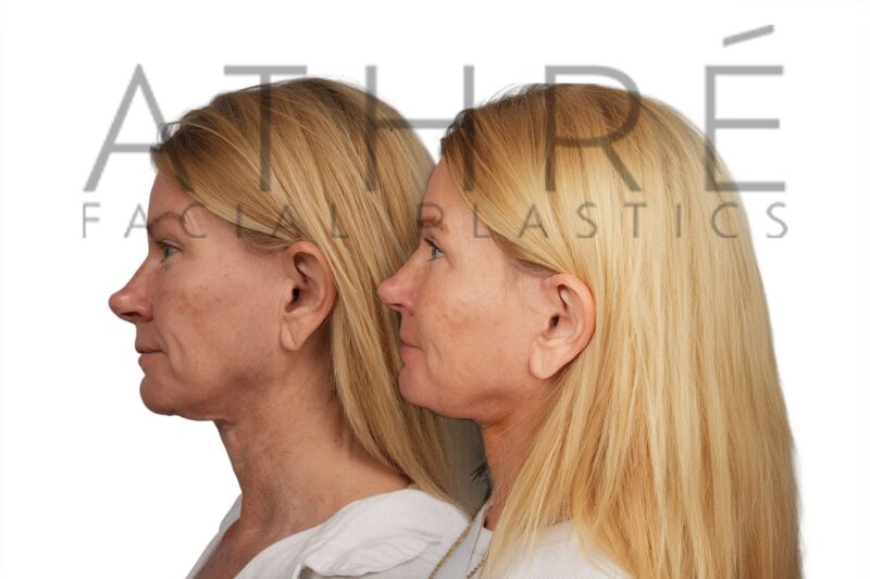 Before and after facial rejuvenation with revision facelift and facial fat transfer by Dr. Raghu Athré.