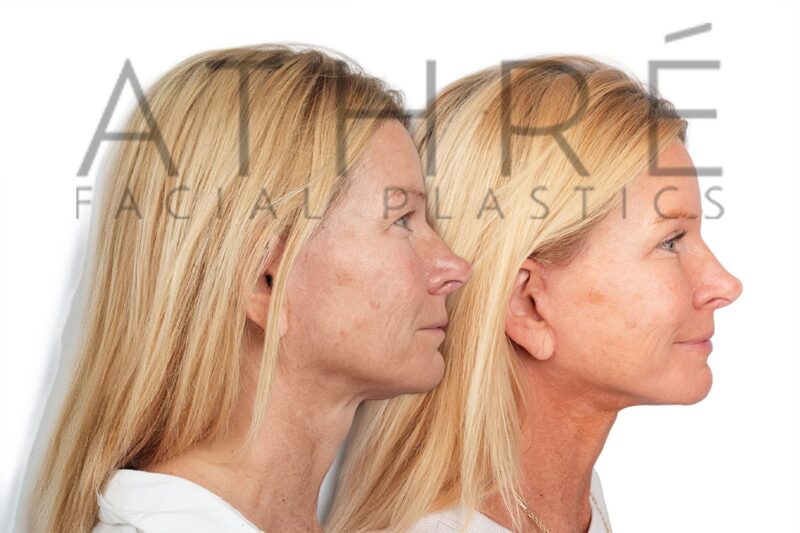 53-year-old woman shown after revision neck lift and stem cell nanofat treatment performed by Dr. Raghu Athré.