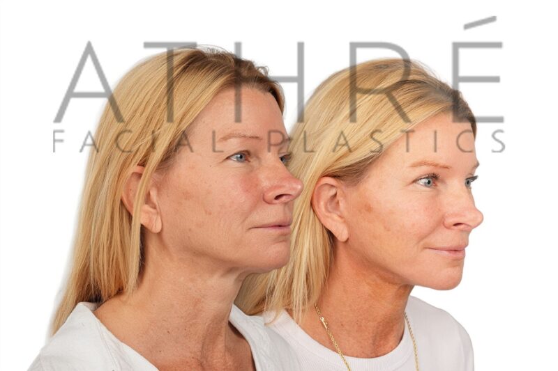 Revision facelift and corrective neck rejuvenation surgery performed by Dr. Raghu Athré.