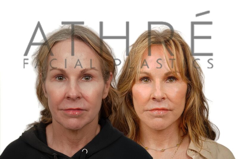 Before and after deep plane facelift and laser blepharoplasty by Dr. Raghu Athré in 59-year-old female patient.
