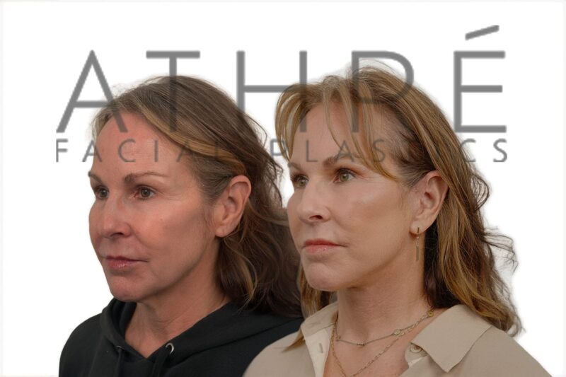 Female patient after 4D Facelift™, lip lift, and deep neck lift by Dr. Raghu Athré.
