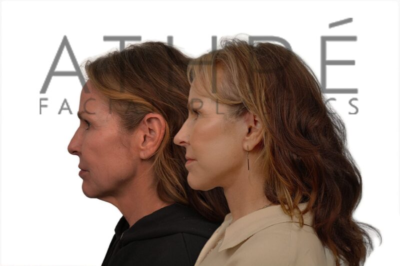 Before and after facial rejuvenation with facelift and under-eye laser surgery by Dr. Raghu Athré.