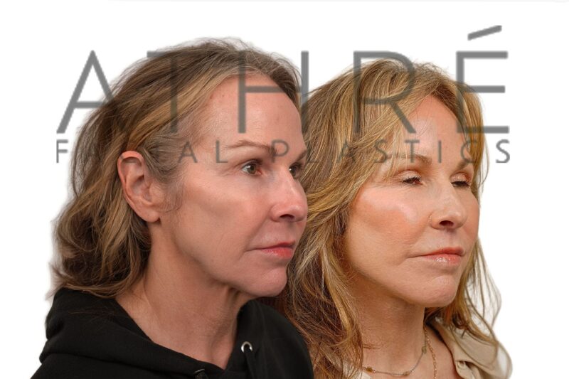 59-year-old woman shown after stem cell nanofat treatment and lip lift performed by Dr. Raghu Athré.