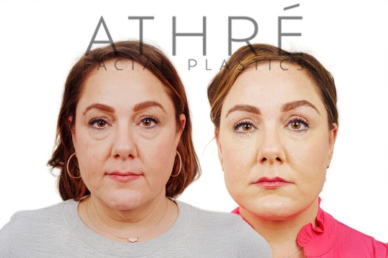 Before and after deep plane facelift and blepharoplasty by Dr. Raghu Athré in female patient.