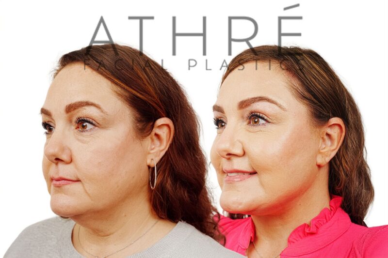 Female patient after 4D Facelift™, deep neck lift, and facial fat transfer by Dr. Raghu Athré.