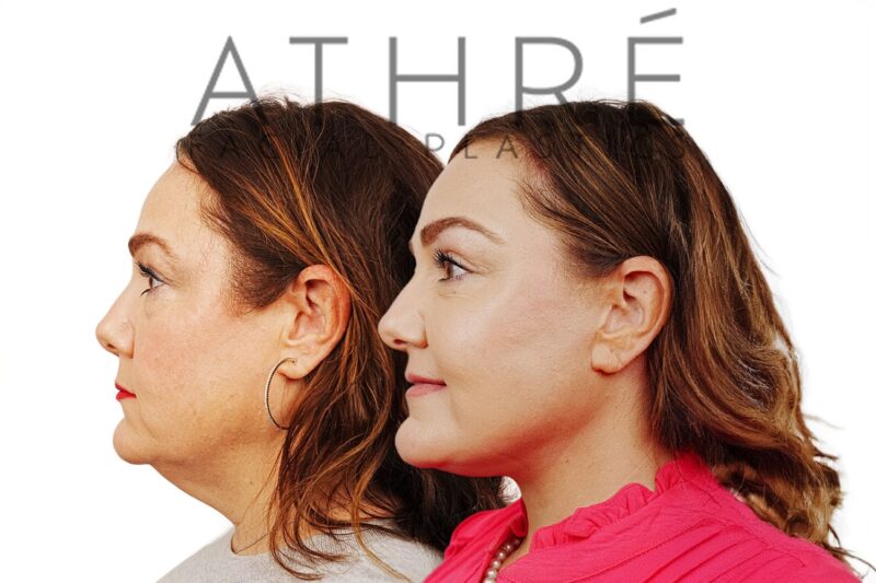 Before and after facial rejuvenation with facelift and full-face chemical peel by Dr. Raghu Athré.