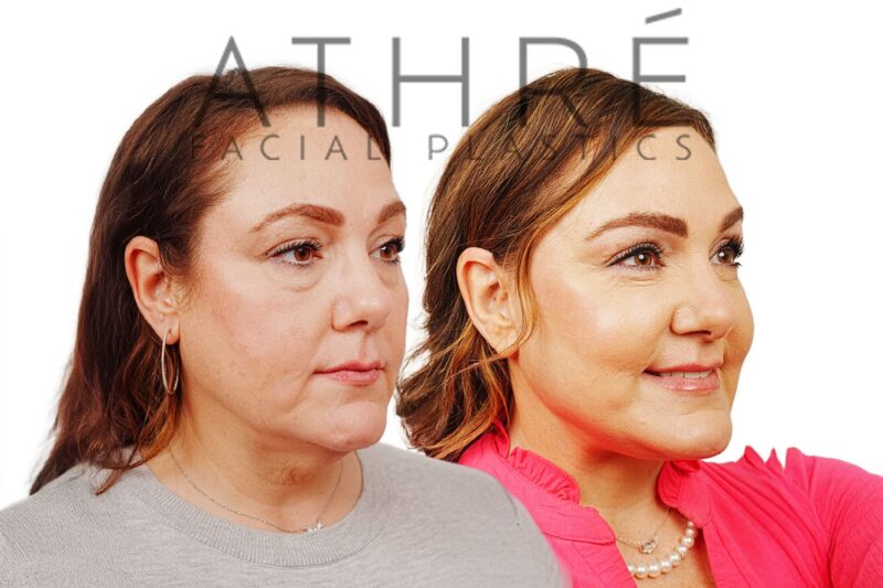 Female patient shown after lip lift and stem cell nanofat treatment performed by Dr. Raghu Athré.
