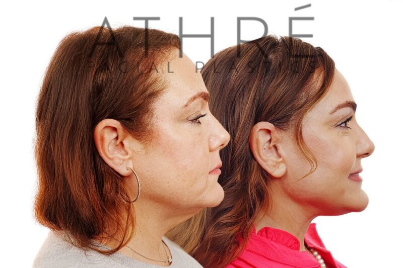 Female patient shown after 4D Facelift™, deep neck lift, upper and lower blepharoplasty, facial fat transfer, and full-face chemical peel with lip lift.