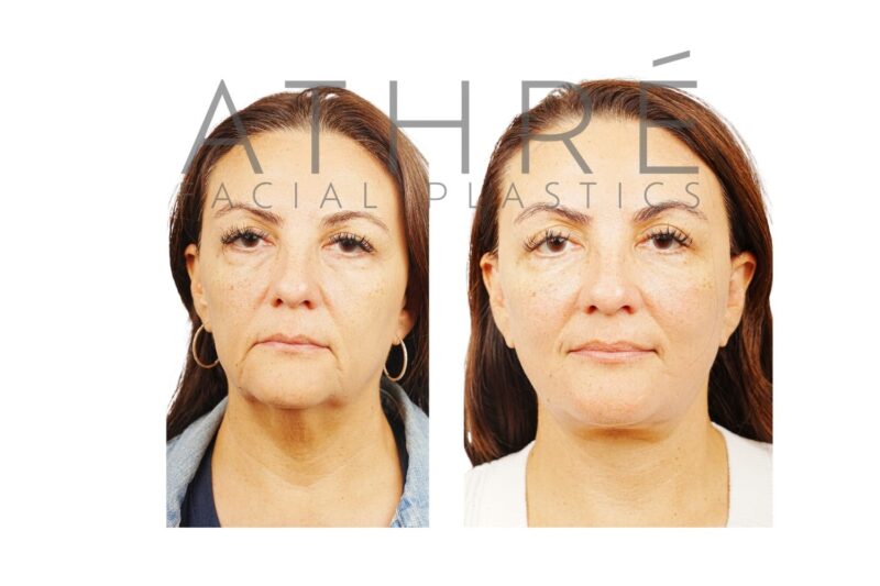 Before and after deep plane facelift and blepharoplasty by Dr. Raghu Athré in 56-year-old female patient.