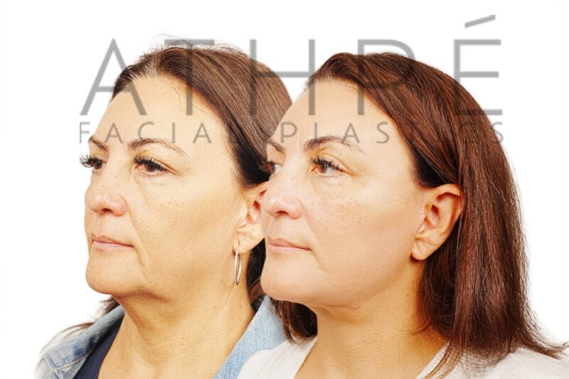 Female patient after 4D Facelift™, deep neck lift, and facial fat transfer by Dr. Raghu Athré.