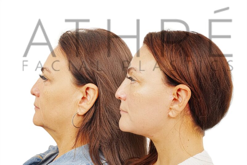 Before and after facial rejuvenation with facelift and eyelid surgery by Dr. Raghu Athré.