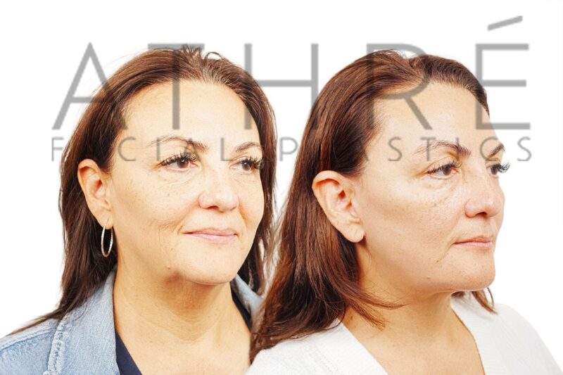 56-year-old woman shown after upper and lower blepharoplasty and stem cell nanofat treatment performed by Dr. Raghu Athré.