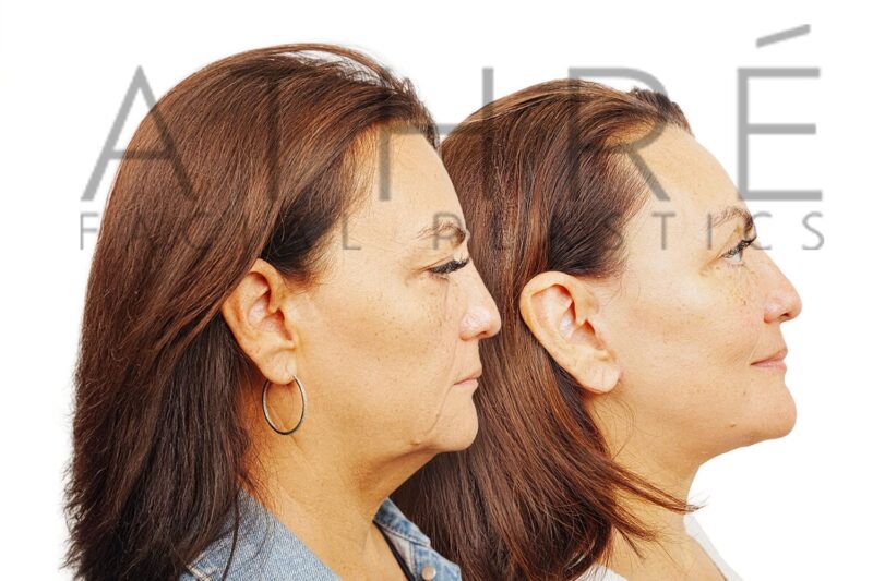 Facial rejuvenation surgery including facelift and blepharoplasty performed by Dr. Raghu Athré.