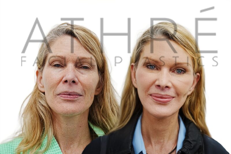 Before and after revision deep plane facelift and upper lip lift by Dr. Raghu Athré in 58-year-old female patient.