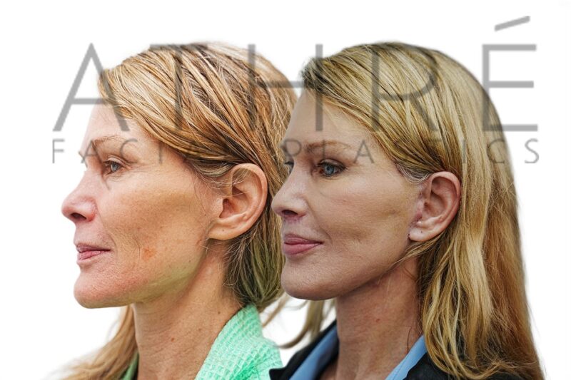 Female patient 9 days after revision 4D Facelift™, deep neck lift, and facial fat transfer by Dr. Raghu Athré.