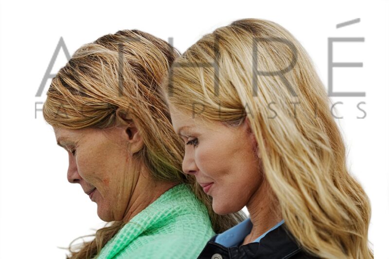 58-year-old woman shown after stem cell nanofat treatment and facial resurfacing performed by Dr. Raghu Athré.