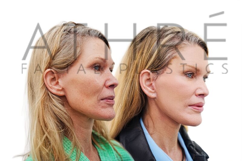 Revision facelift and facial rejuvenation surgery performed by Dr. Raghu Athré.