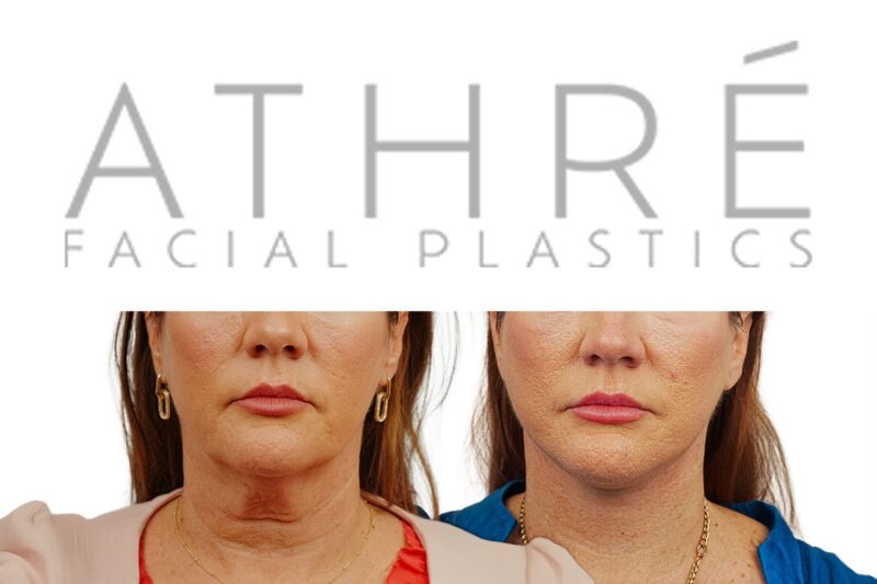 Before and after deep plane facelift, brow lift, and upper blepharoplasty by Dr. Raghu Athré in 48-year-old female patient.