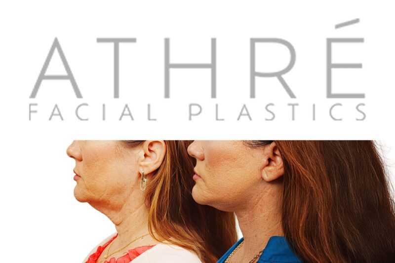 Female patient after 4D Facelift™, deep neck lift, and facial fat transfer by Dr. Raghu Athré.