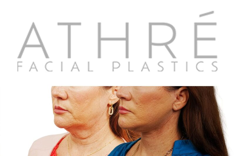 Before and after facial rejuvenation with facelift and under-eye laser resurfacing by Dr. Raghu Athré.