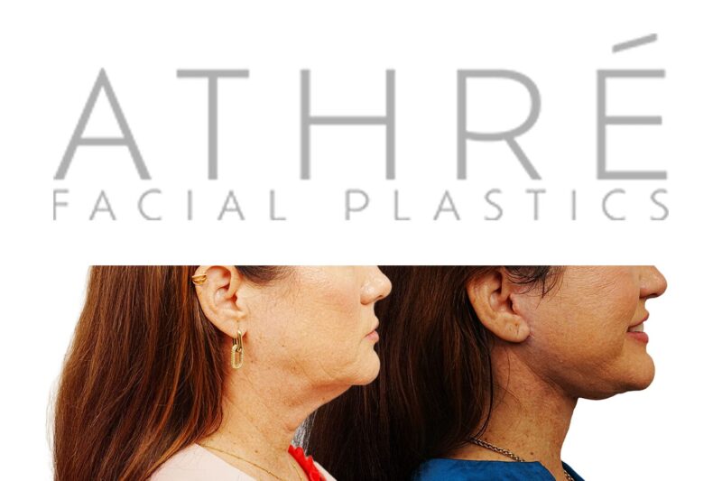 Facial rejuvenation surgery including facelift and upper eyelid surgery performed by Dr. Raghu Athré.