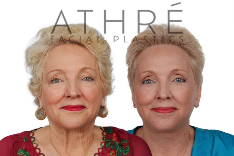Before and after revision deep plane facelift and neck lift by Dr. Raghu Athré in 70-year-old female patient.