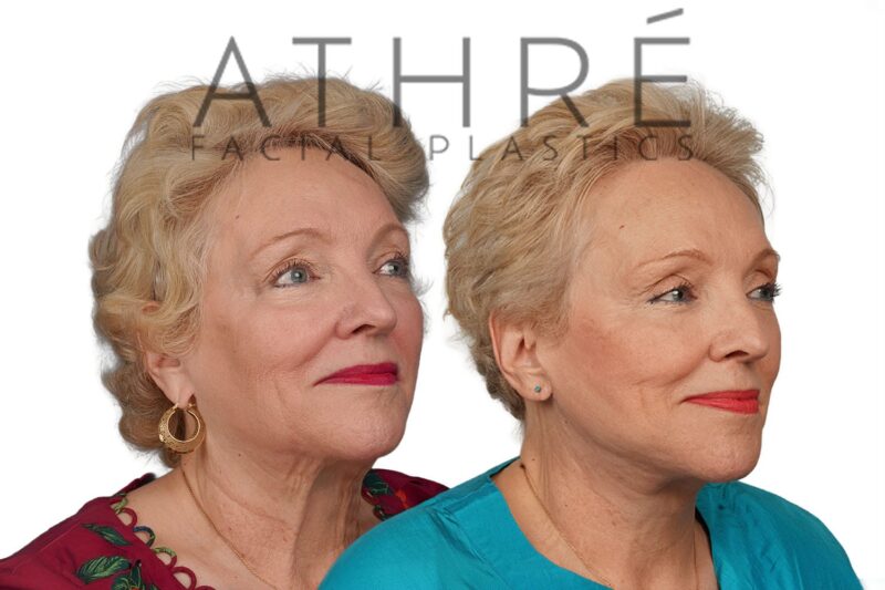Before and after revision deep plane facelift and neck lift by Dr. Raghu Athré in 70-year-old female patient.