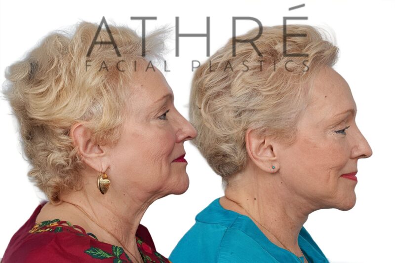 Before and after revision deep plane facelift and neck lift by Dr. Raghu Athré in 70-year-old female patient.