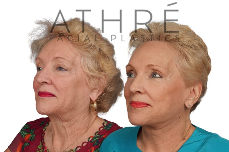 70-year-old woman after revision 4D Facelift™, upper blepharoplasty, and facial fat transfer by Dr. Raghu Athré.