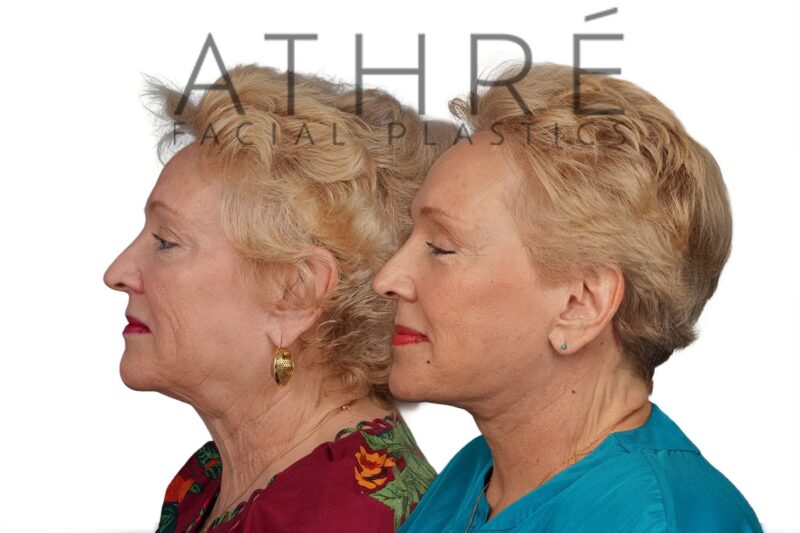 Before and after facial rejuvenation with revision facelift and chemical peel by Dr. Raghu Athré.