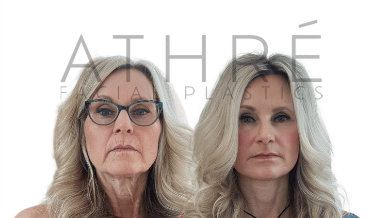 Before and after comprehensive facial rejuvenation with 4D Facelift by Dr. Raghu Athré.