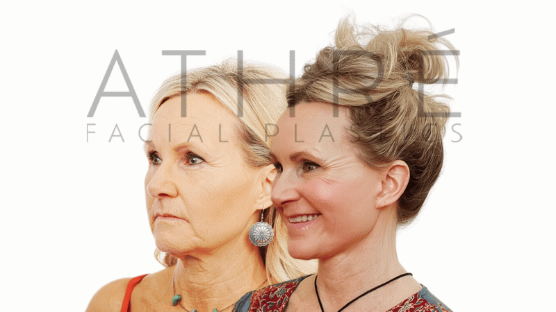 57 year old patient before and after 4D Facelift and brow lift by Dr. Raghu Athré.