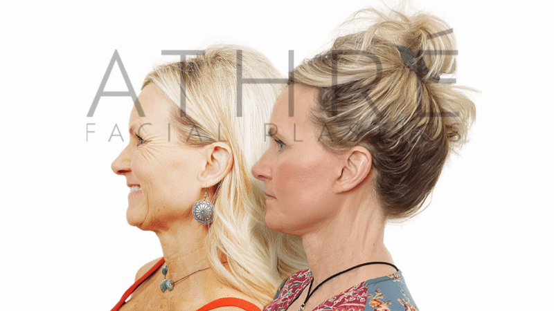 Before and after deep plane facelift neck lift and chemical peel by Dr. Raghu Athré.