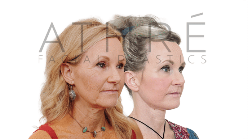 57 year old female before and after deep plane facelift by Dr. Raghu Athré.