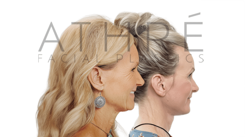 Before and after 4D Facelift and temporal brow lift by Dr. Raghu Athré.