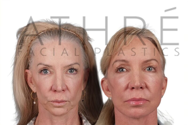 Before and after revision upper blepharoplasty and revision facelift by Dr. Raghu Athré.