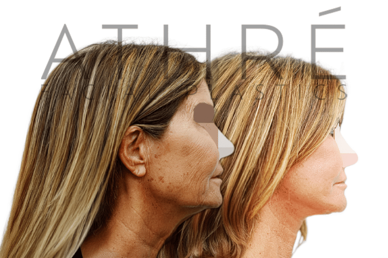 Before and after 4D Facelift with deep plane facelift and neck lift in female patient in her 60s by Dr. Raghu Athré.