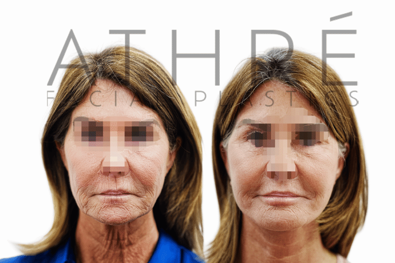 Female patient shown before and after facial rejuvenation surgery with 4D Facelift and chemical peel by Dr. Raghu Athré.