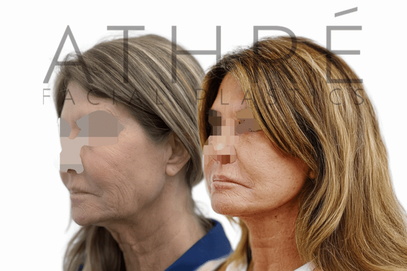 Before and after deep plane facelift and deep neck lift performed by Dr. Athré on female patient in her 60s.
