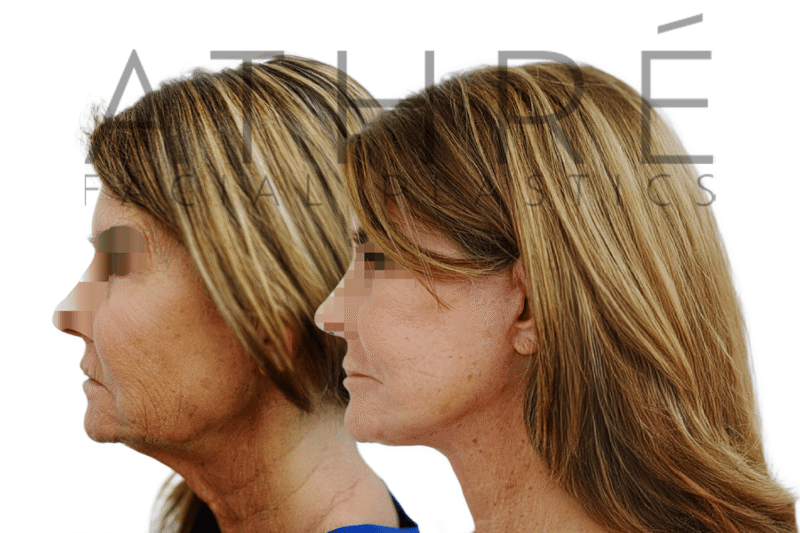 Mid-60s woman after 4D Facelift facial rejuvenation including facelift, neck lift, and fat transfer by Dr. Raghu Athré.