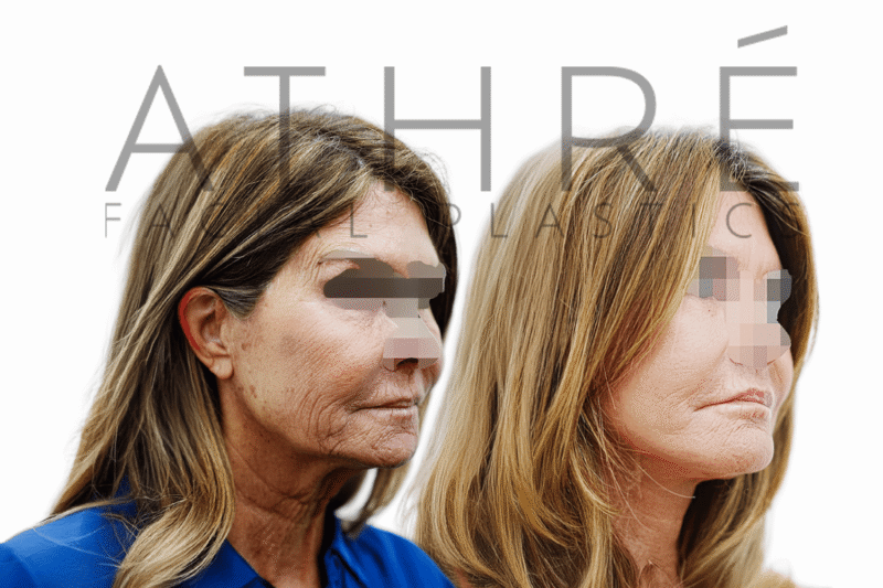 Female patient before and 3 weeks after deep plane facelift, deep neck lift, fat transfer, and chemical peel by Dr. Raghu Athré.